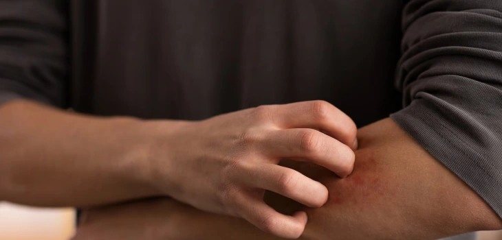 Eczema Treatment In Gurgaon