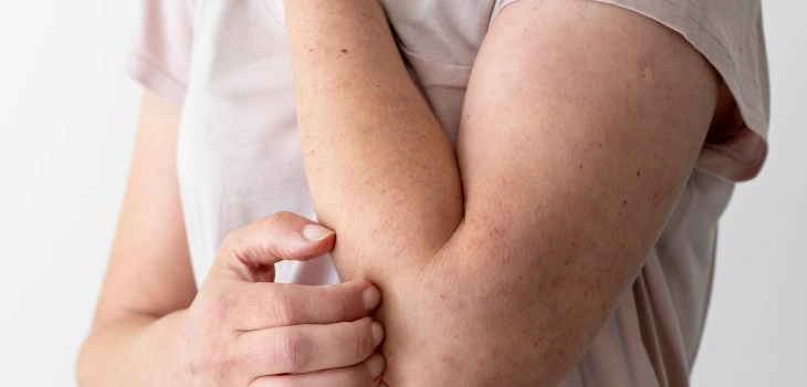 Fungal Infection Treatment in Gurgaon