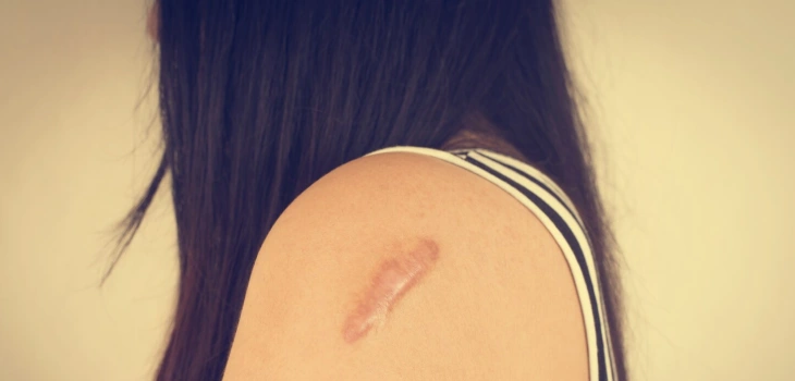 Keloid Treatment in Gurgaon