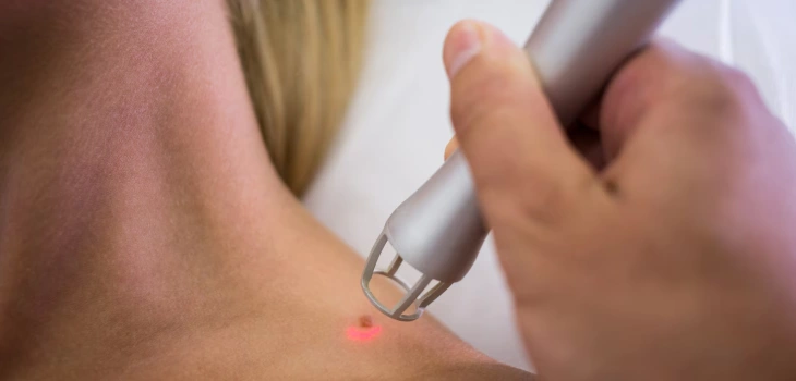 Mole Removal Treatment in Gurgaon