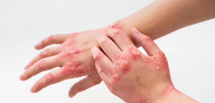 Psoriasis Treatment in Gurgaon