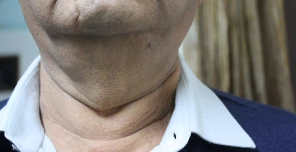 Skin Tightening After