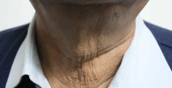 Skin Tightening Before