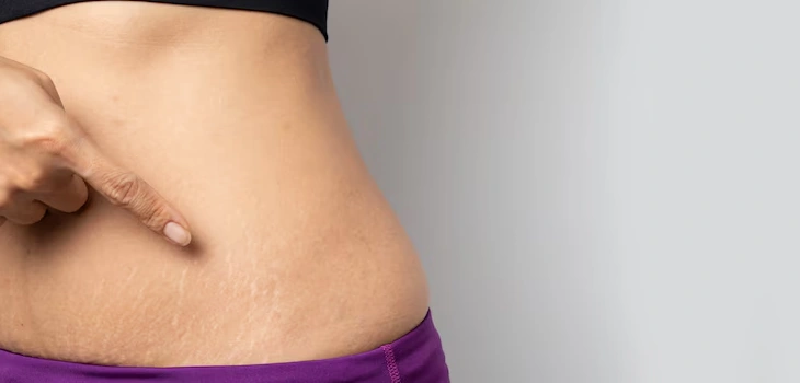 Stretch Marks Treatment In Gurgaon