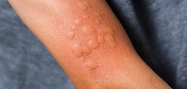 Urticaria Treatment in Gurgaon