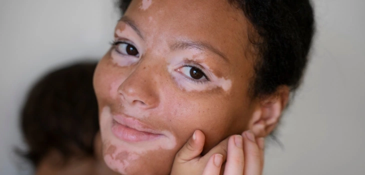 Vitiligo Treatment in Gurgaon