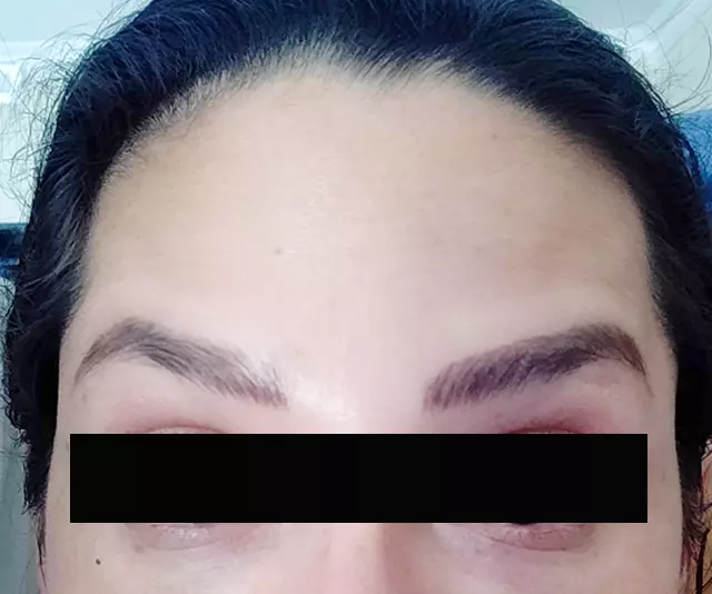 Anti Wrinkle Injections After
