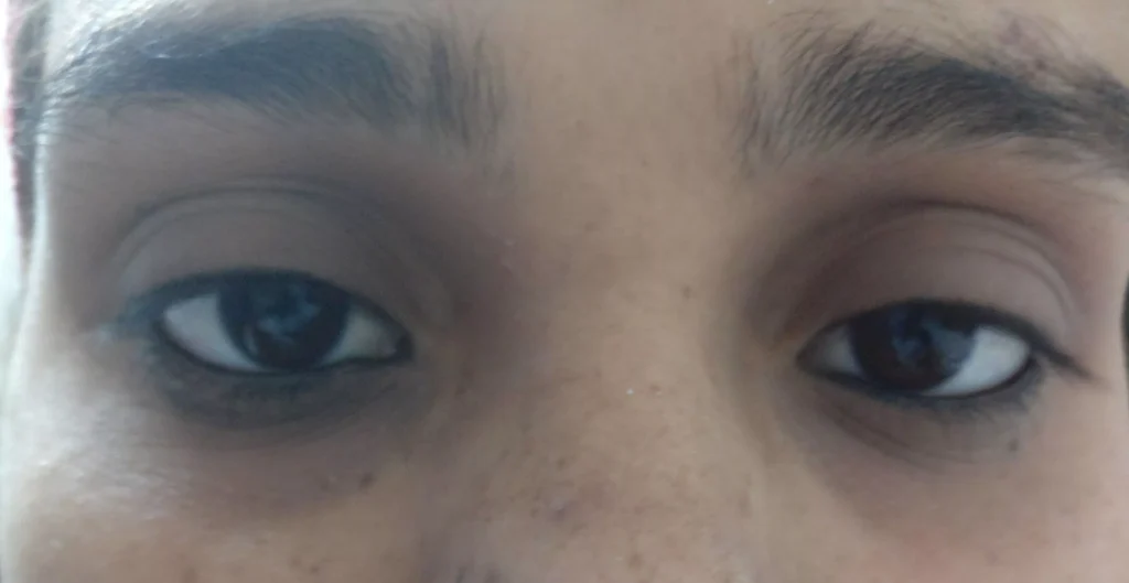 Before Eye Fillers