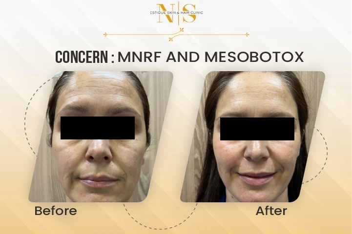 mnrf mesobotox before after