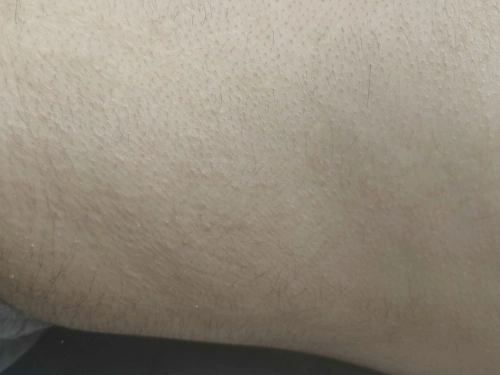 stretch mark after