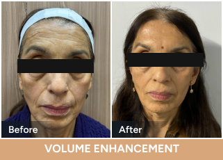 Volume Enhancement