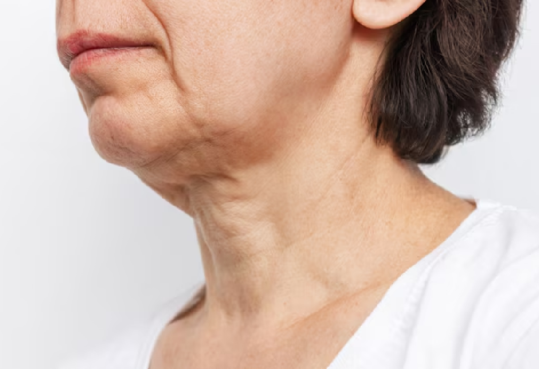 Sagging Skin Treatment