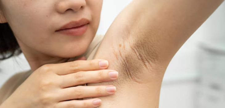Acanthosis Nigricans Treatment