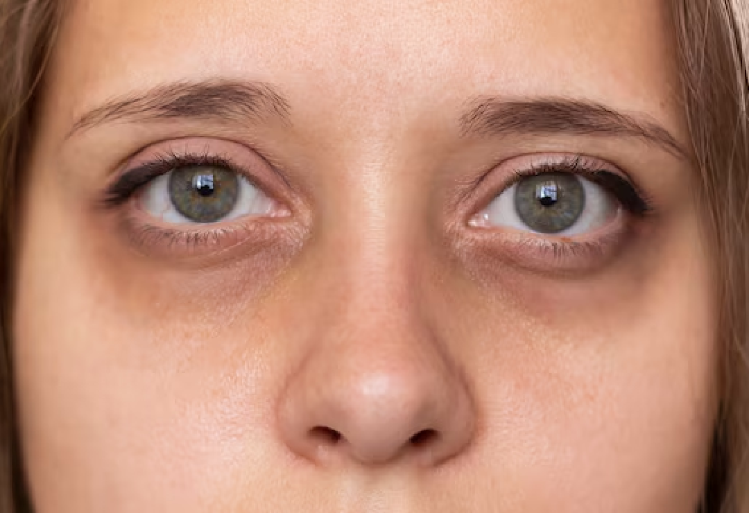 Dark Circles Treatment In Gurgaon
