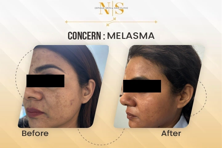 Melasma Treatment In Gurgaon