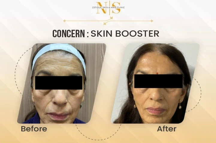 Skin Booster Before & After Image 2