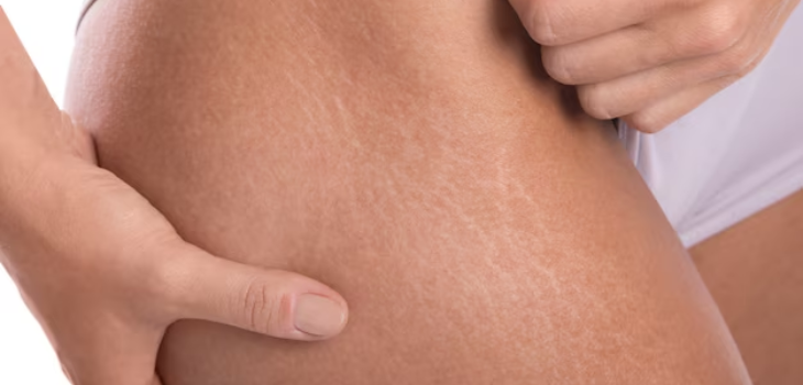 Stretch Marks Treatment In Gurgaon