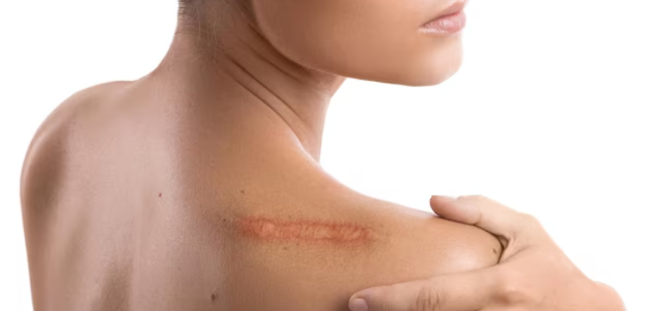 Scar Removal in Gurgaon