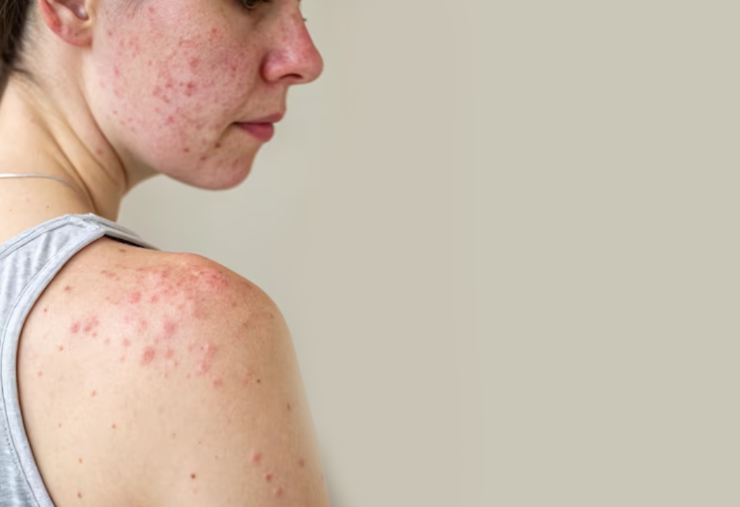 Acne Vulgaris Treatment