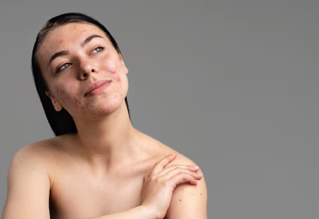 Acne-Scar-Treatment
