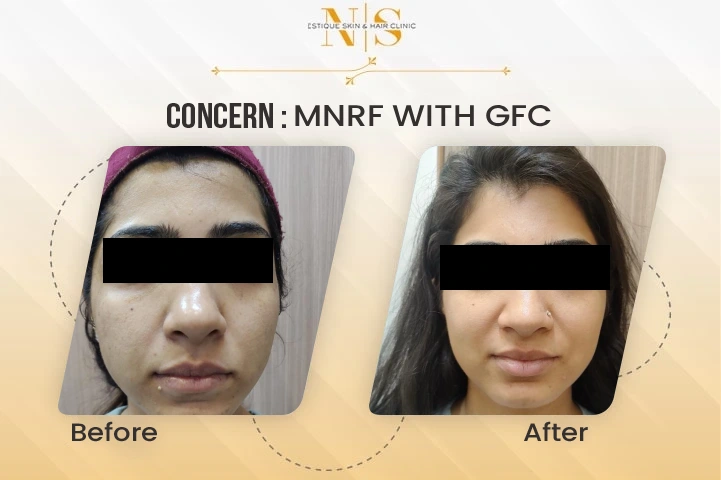 mnrf with gfc before and after
