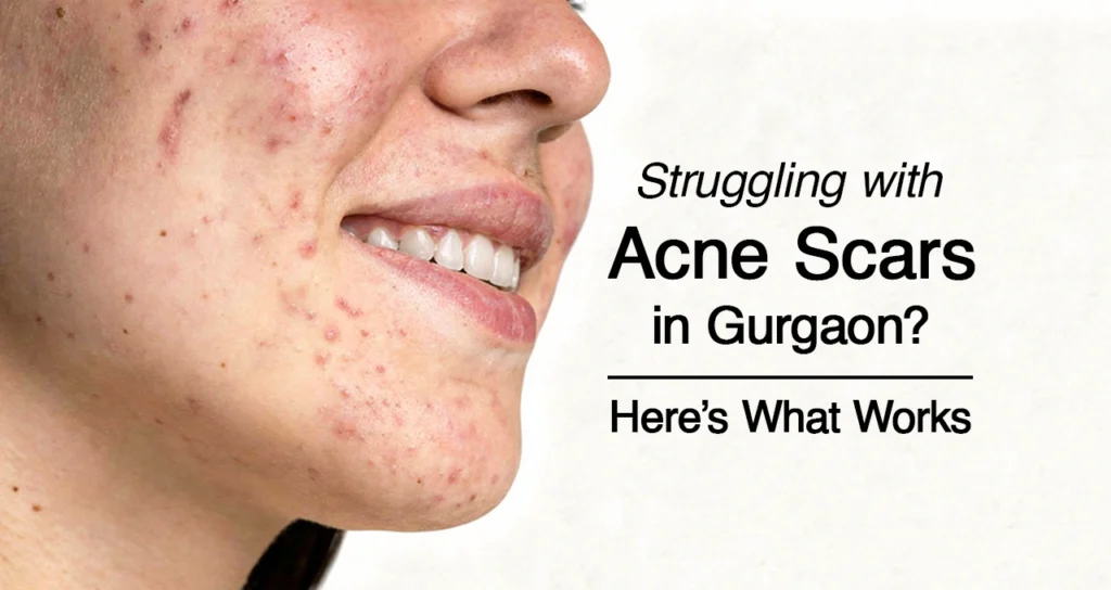 Close-up of a person with visible acne scars and pimples on the face alongside the text “Struggling with Acne Scars in Gurgaon? Here’s What Works” promoting acne scar treatment solutions.