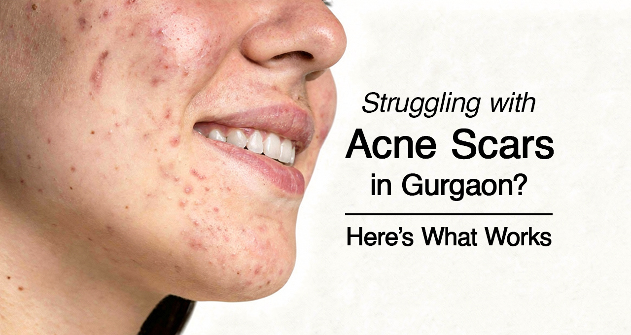 Close-up of a person with visible acne scars and pimples on the face alongside the text “Struggling with Acne Scars in Gurgaon? Here’s What Works” promoting acne scar treatment solutions.