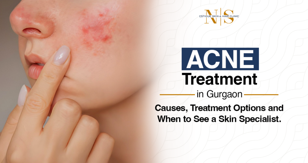 Acne Treatment in Gurgaon: Causes, Treatment Options and When to See a Skin Specialist.