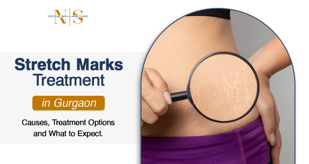 Stretch Mark Treatment in Gurgaon: Causes, Treatment Options and What to Expect